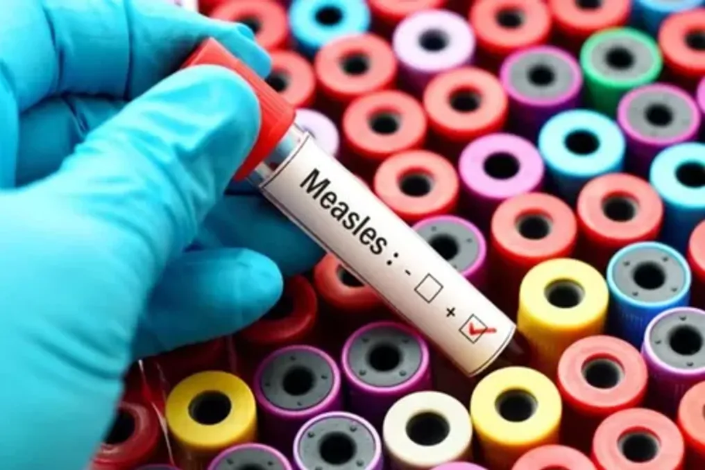 Measles outbreak observed in Cape Town: Health Department urges parents to vaccinate children