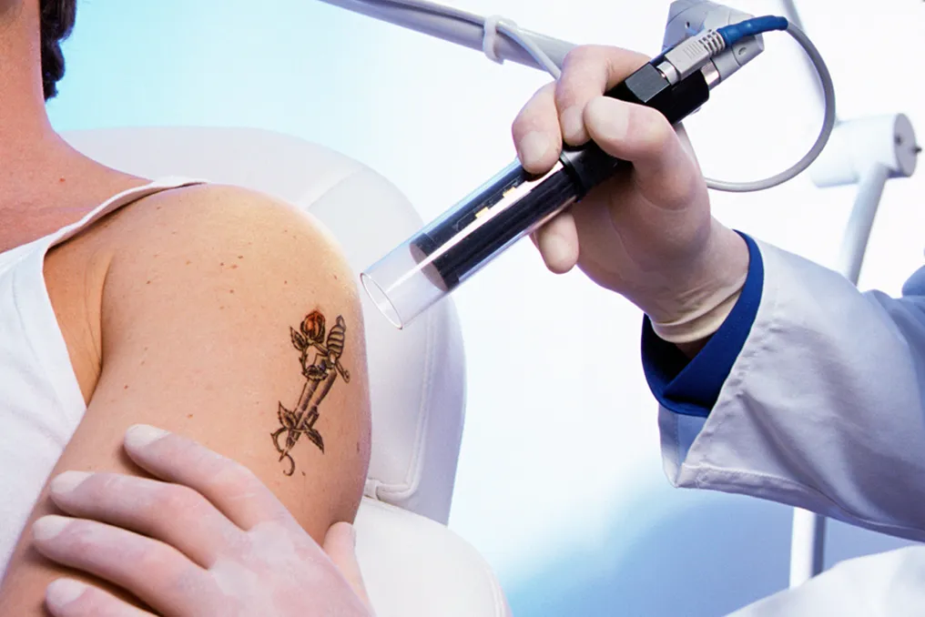 Para onde vai a tinta de tatuagem após remoção a laser?