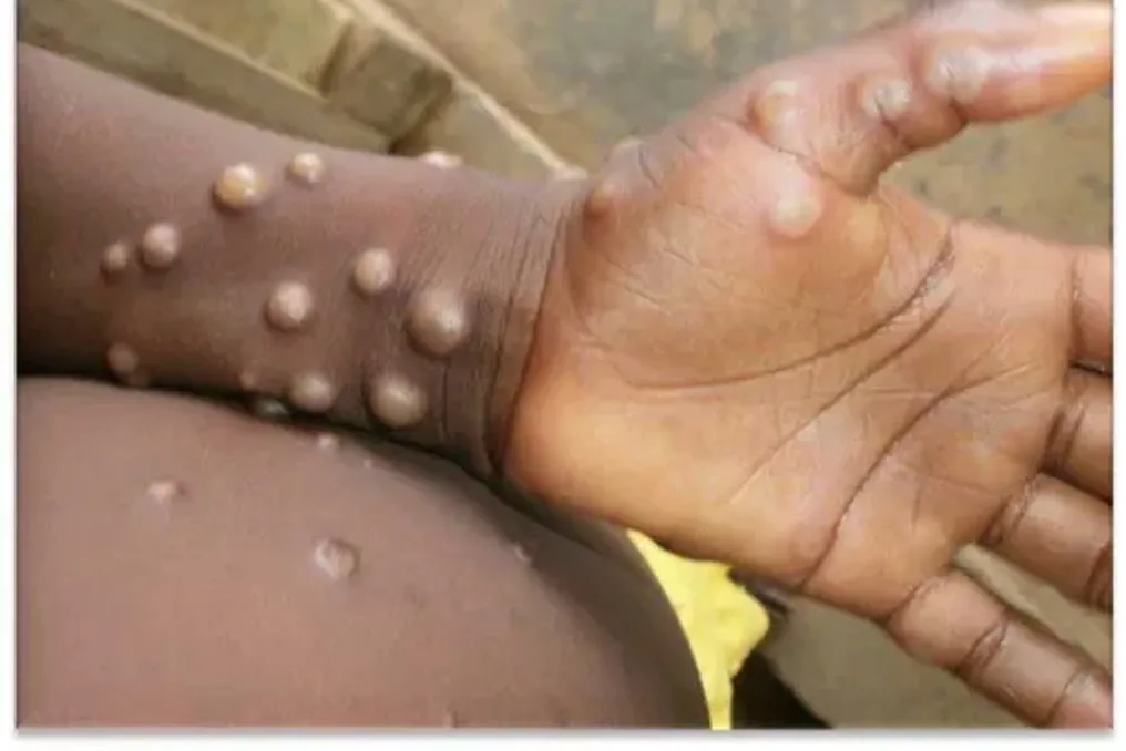 Número de casos de Mpox na África do Sul sobe para 22