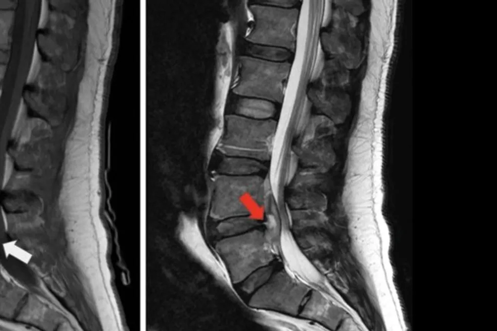 Cientistas descrevem caso de brucelose vertebral manifestada como abscesso epidural