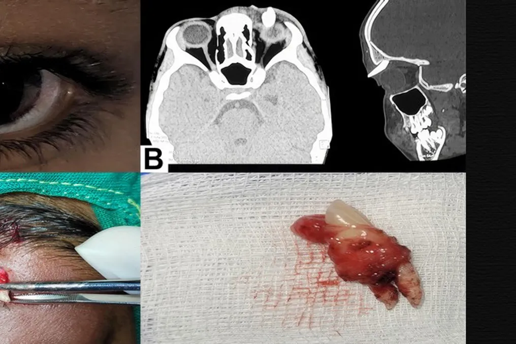 Formation resembling a canine tooth found under the upper eyelid of Indian teenager
