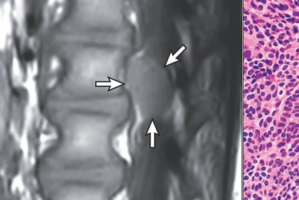Experimental gene therapy caused tumor in boy with Krabbe disease
