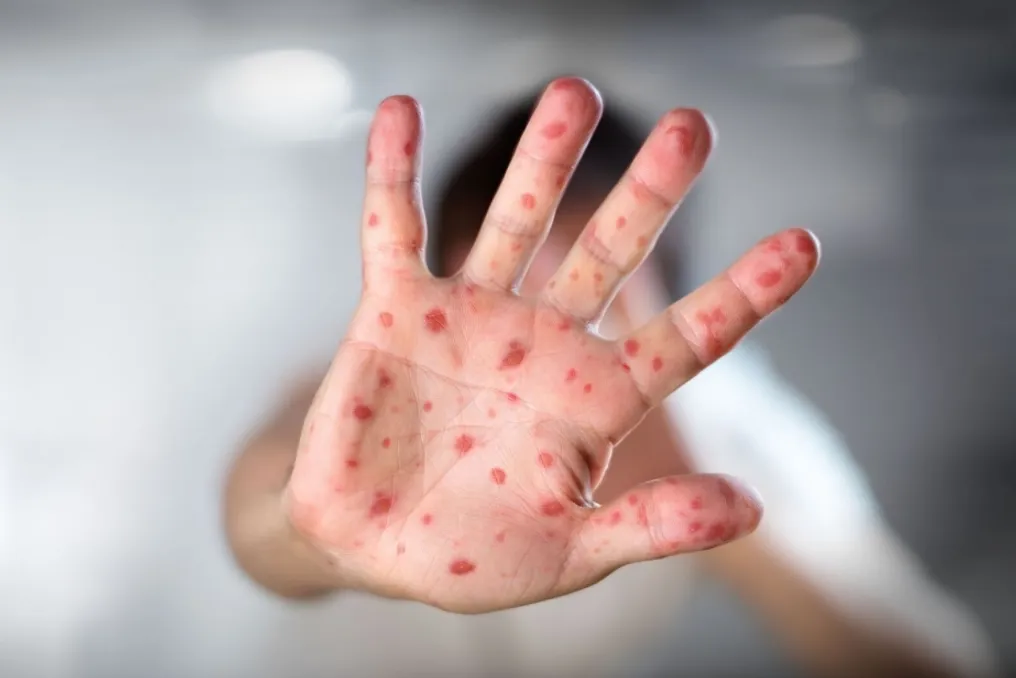 Sanitariya-epidemiya qoʻmitasi Toshkentdagi koʻrlik epidemiyasi haqidagi xabarlarni inkor etdi va statistikani aniqlashtirdi