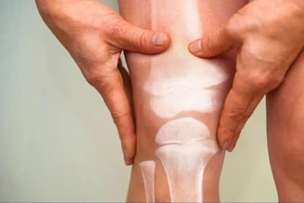 Dia Mundial da Osteoporose: Fragilidade Óssea e Métodos de Prevenção da Doença