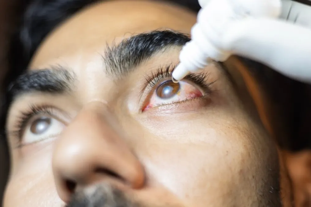 Expert explains whether to rinse eyes with water or use drops when experiencing burning and itching