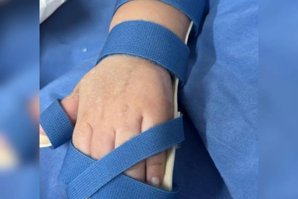 Physiotherapy students create personalized orthosis to aid in the rehabilitation of a child in Tocantins